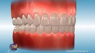 Intraoral Single