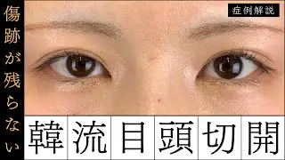 【症例解説】傷跡が残らない！韓流目頭切開ってなに？