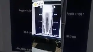scanogram knee #hospital #shortvideo #sanjay 🥰#surgeryreview 🤗