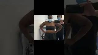 Celebrity Arms&trade; | 360&deg; Arm Liposuction | Immediate Results | Expert Dr. Thomas Su | Artlipo