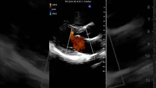 Cardiac Color Mitral Regurgitation | Clinical Image