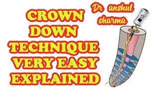 CROWN DOWN TECHNIQUE ANTERIOR WIDE CANAL