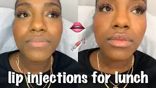 I GOT MY LIPS DONE ON MY LUNCH BREAK AT SEV LASER | LIP FILLER VLOG