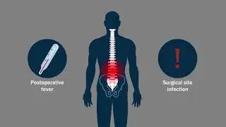 Sustained Postop Fever WO Evident Cause After Spine Instrumentation as  Ind. of Surg. Site Infection