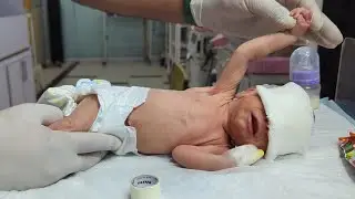 Low Birth Weight in Babies | Causes, Symptoms& Care Tips for Newborns ❤️🍼 #lbw #baby #nicubaby