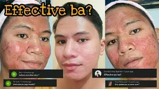 Derma Pen 3rd Session + Question and Answer About Microneedling | DYNEL BEO