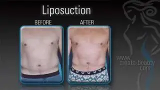 Liposuction - Body Contouring in Dallas and Plano, Texas