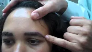 Eyebrow Transplant