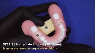 Atraumatic Ridge Preservation ARP BoneModels Workshop III - ARP with Immediate Implant Placement