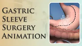 Gastric Sleeve Surgery Animation | Clinic Bariatric