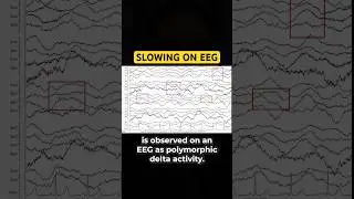 What does an #EEG look like in a patient with CGS?