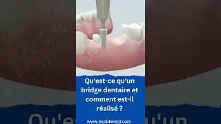 Bridge Dentaire - solution pour remplacer une ou plusieurs dents #dentaire #bridgedentaire  #shorts