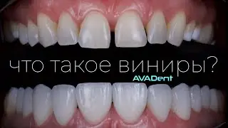 AVADent. Что такое виниры?