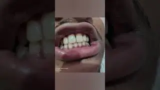 #viralvideo#dentist#dentistry#smile#shorts#shortvideo#song#funny#veneers#doctor#smiledesigndental