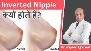 Inverted Nipple क्यो होते है? ✅Causes and Treatment for Inverted Nipples ✅Grades of Nipple Inversion