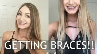 GETTING CLEAR CERAMIC BRACES! | Week 1