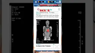 As shown in the CT diagnosis. the patient said the heart was badly hurt beforecannot wait any longer