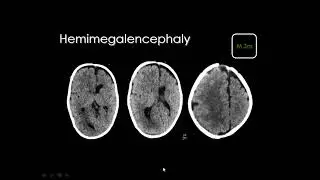 Pediatric brain imaging, disorders of cortical formation DRE Prof  Mamdouh HD