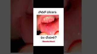 Beware of mouth ulcers.! | #shorts #trending #ytshorts #yt #dentist #dentaltreatment #telugu
