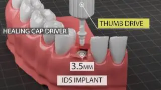 Insight Dental Systems | Implant System