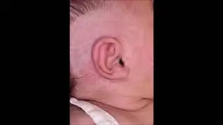Lop Ear - EarWell&trade; System - Dr. Eric Payne - Houston, TX