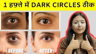 Remove Dark Circles Permanently in 7 Days | Extreme Dark Circles Remedy | 100% Results