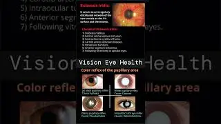 Rubeosis Iridis | Color reflex of the Pupillary area.