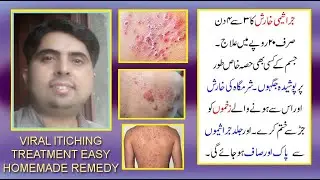 jeraseemi kharish ka ilaj in urdu/hindi | viral / bacterial itching homemad remedy by jolly azeem |
