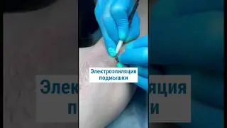 Электроэпиляция подмышечной впадины