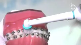 Mundhygiene Zahnspange