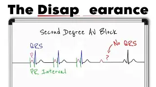 Second-Degree AV Block ECG Explained | Wenckebach vs Mobitz Type II (ECG Made Easy)