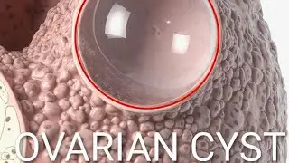 How to Detect Ovarian Cysts Early + Best Treatments Women Should Know. Is This Pain an Ovarian Cyst?