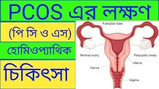 PCOS Symptoms & Treatment | Period Problem? Best Homeopathic Medicine Explained |Dr.Arif Hossain
