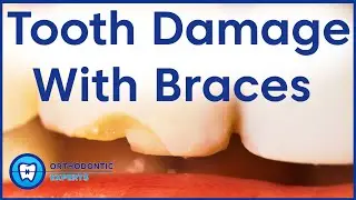 How Damaged Teeth Affect Braces | Chipped Tooth