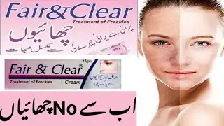 Say Goodbye to freckles | Fair & Clear Freckles cream | How to remove your dark spots & freckle#acne