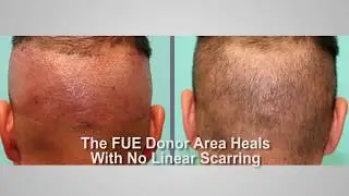 Advantages of Follicular Unit Extraction Hair Transplant Surgery FUE   by Dr  Michael Vories