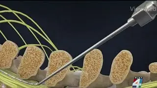 Neurostimulators offer pain relief without pills