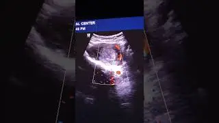 RPOC Retained Products of Conception on Ultrasound