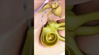 How Cochlear Implant Works?(3D Animation)#cochlearimplant #cochlearimplants #hearingloss