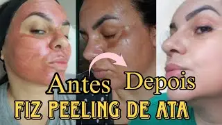 Fiz o Peeling de ATA para Fechar os Poros e Acne/Vale a Pena? Valor e Dura&ccedil;&atilde;o 💉