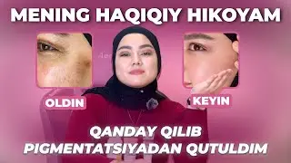 MENING HAQIQIY HIKOYAM: QANDAY QILIB PIGMENTATSIYADAN QUTULDIM &mdash; COMAX.UZ