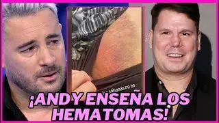 ¡BRUTAL! ¡SUPUESTA PELEA EN LOS CAMERINOS ENTRE ANDY Y LUCAS! ANDY ENSEÑA LOS HEMATOMAS