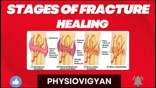 Fracture Healing Pathology ll Fracture Healing Orthopaedic , Fracture Healing Stages , Healing Notes