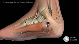 SafeView Animation Series: Endoscopic Tarsal Tunnel Release