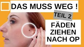 Fadenzug nach Exzsion (Hautmalentfernung) LIVE DABEI TEIL 2