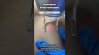 Laser Stretchmark #treatment #laser #hongkong #laserbopeng #co2laser #treatment