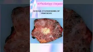 Tumors with central scar, #Central scar differentials, #pathology, #Gross images, #quizquestions