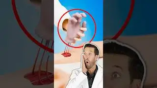 Врач смотрит на то как врачи пришили руку к ноге (Zack D. Films)