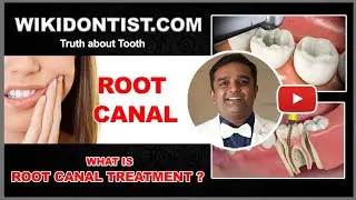What is Root Canal Treatment? / Dr.Thomas Nechupadam / Nechupadam Dental Kochi