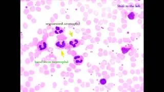 Leukemia vs. Lymphoma & Leukomoid Reaction